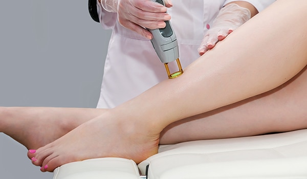 laser hair removal 